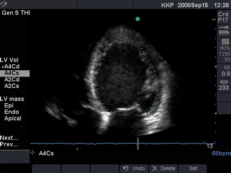 Echo Pocket Icu Cardiac Sonography Echocardiogram Echo