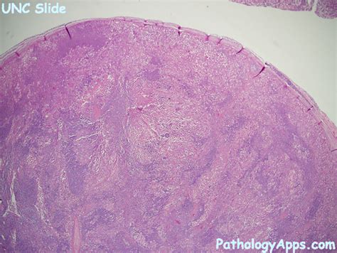Rosai Dorfman Disease Lymph Node Histology