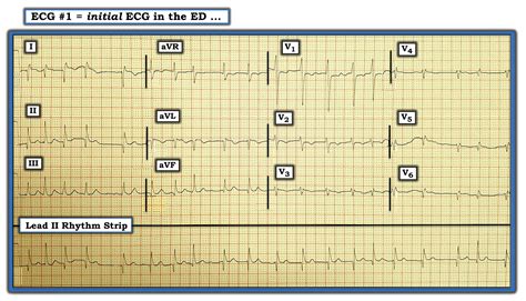 Ecg Interpretation Ecg Blog 175 Lead Reversal Lateral Mi