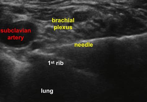 Color Doppler Ultrasound Guided Supraclavicular Brachial Plexus Block