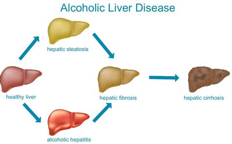 Liver Disease Treatment Liver Specialists And Expert Surgeons Perth