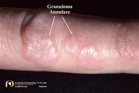 Granuloma Annulare Palisaded Granulomatous Dermatoses Academic