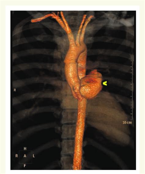 Computed Tomography Scan Of Aortic Root And Ascending Aorta Confirming