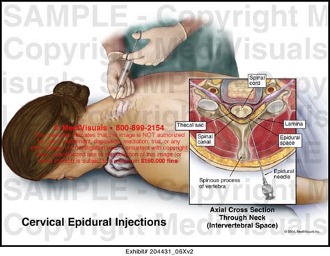 Cervical Epidural Injections Medical Illustration Medivisuals