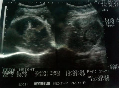 Tiffany dinyatakan resmi mengandung sejak 11 minggu lalu dan kini sedang sangat berbahagia dengan kehamilannya. Usia kehamilan 36 Minggu, hasil test lab Hb rendah ...