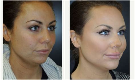 Cheek Fillers Before And After Realself Before And After