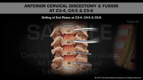 What To Expect After 3 Level Cervical Fusion Annalee Hutchison