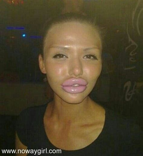 Duck Faaaaaaace Wtf Botox Lips Plastic Surgery Gone Wrong Fake Lips