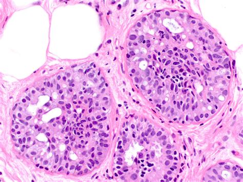 Pathology Outlines Usual Ductal Hyperplasia