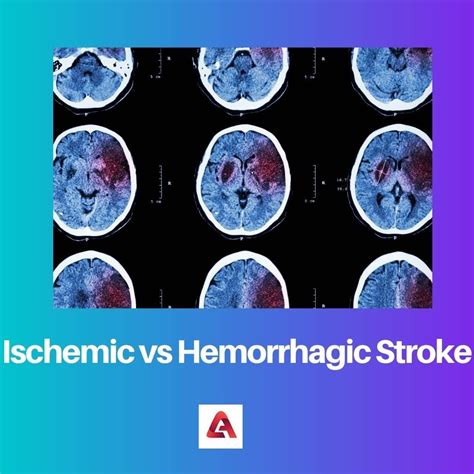 Ischemic Vs Hemorrhagic Stroke Difference And Comparison