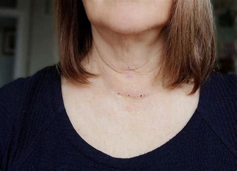 Scar And Dressing Post Endocrine Surgery
