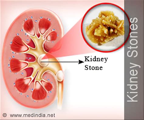 How To Avoid A Kidney Stone Plantforce21