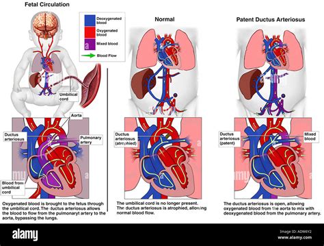 Congenital Heart Defects Patent Ductus Arteriosus Stock Photo