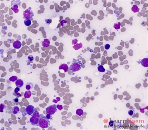 Diffuse Large B Cell Lymphoma Learnhaem Haematology Made Simple