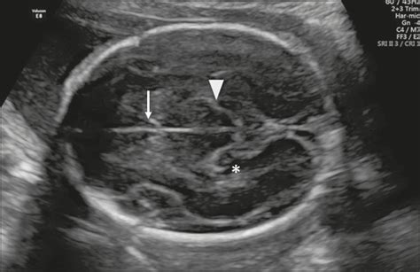 Scielo Brasil Ultrasonographic Evaluation Of The Fetal Central
