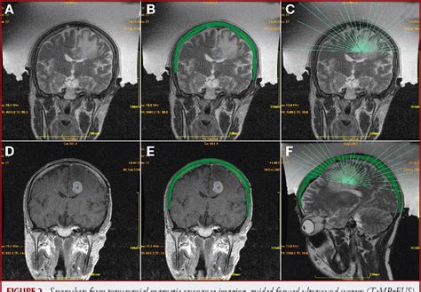 Figure 1 From Transcranial Magnetic Resonance Imaging Guided Focused