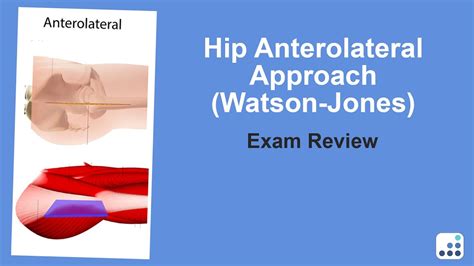 Hip Anterolateral Approach Watson Jones Exam Review Doug Padgett