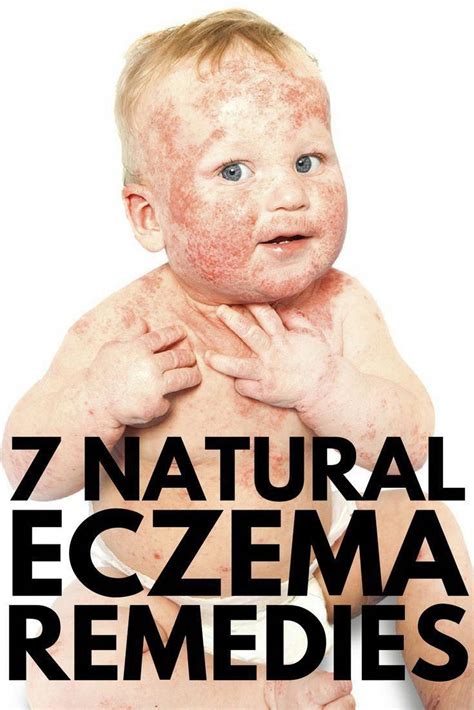 If Youre On The Hunt For Eczema Remedies That Work Quickly And