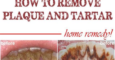 It can be easily removed with daily oral care. Home remedies to remove plaque and tartar | Remedies