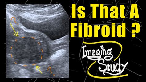 Retroflexed Uterus Mimicking Fibroid Ultrasound Case 121 Youtube
