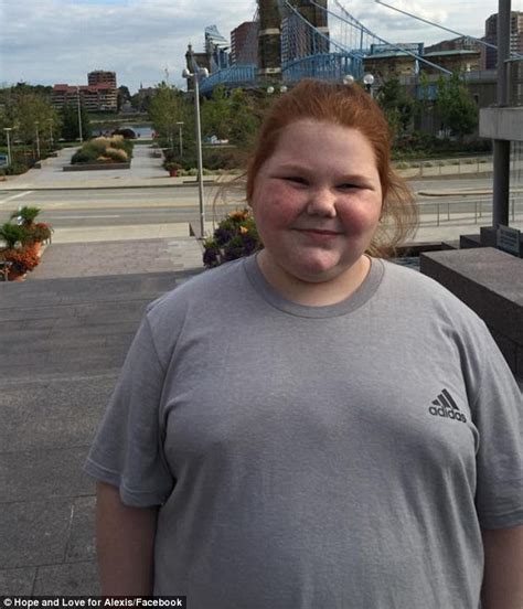 Texas Teen Alexis Shaprio With Hypothalamic Obesity Has