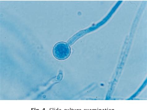 Figure 4 From Kerion Caused By Microsporum Audouinii In A Child