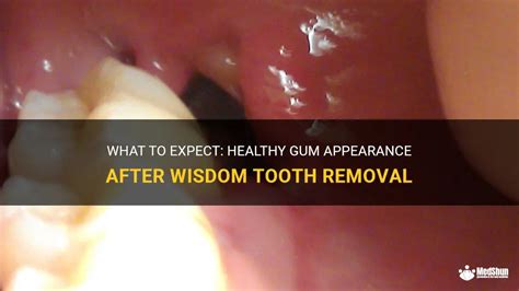What To Expect Healthy Gum Appearance After Wisdom Tooth Removal Medshun
