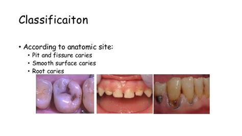 Dental Caries Its Etiology