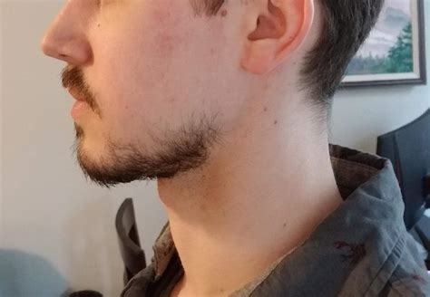 1 Month In No Cheek Or Sideburn Growth Where Should I Go From Here