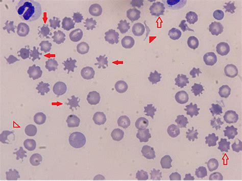 Figure 1 From Erythrocyte And Biochemical Abnormalities As Diagnostic