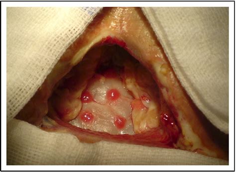 Repair Of Large Abdominal Incisional Hernia By Reconstructing The