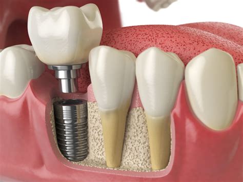 Step By Step Dental Implant Procedure Guide Barkoff Dental