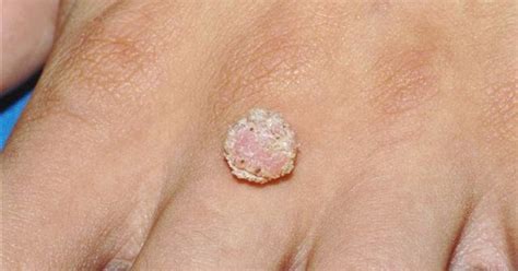Determine If You Have A Warts How To Remove Moles Warts Skin Tags