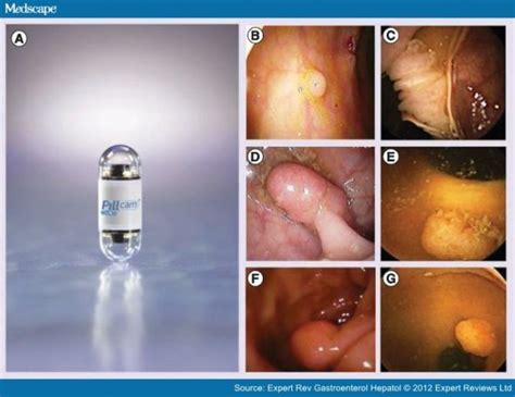 The camera app comes by default with the windows os. PillCam Is A New Endoscopy Camera That You Can Swallow