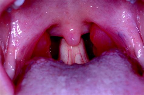 High Rising Epiglottis In Children Should It Cause Concern American
