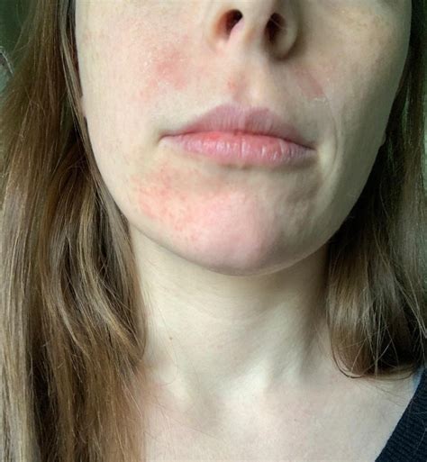 Please Help Im At A Total Loss Rapid Onset Of Redness Dry Patches