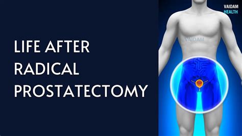 After Radical Prostatectomy