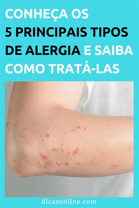 Alergia Na Pele Como Cuidar E Tratar Alergia Na Pele Aprenda Eliminar