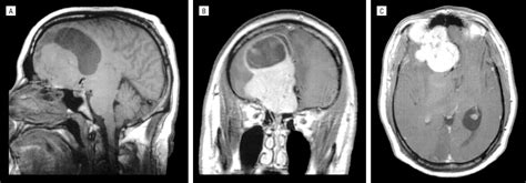 Right Orbitofrontal Tumor With Pedophilia Symptom And Constructional