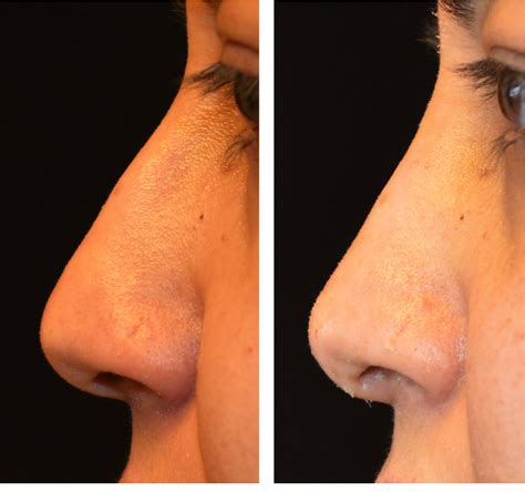 Nose Job Scars How To Avoid Them Justinboey