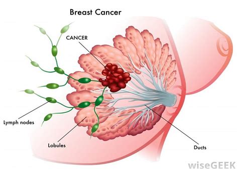 women unclear about breast density breast cancer risks