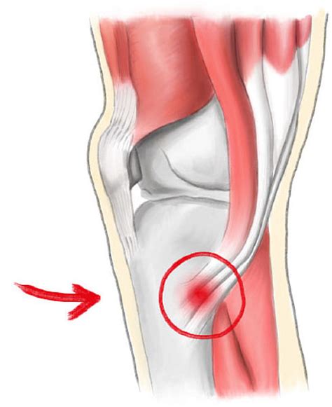 Pes Anserine Bursitis Tendinitis Cause Symptom Treatment Exercise