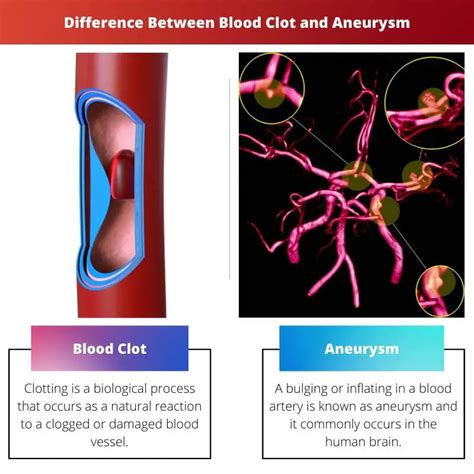 Blood Clot Vs Aneurysm Difference And Comparison