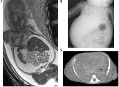 Frontiers Pulmonary Hypoplasia Caused By Fetal Ascites In Congenital Cytomegalovirus Infection