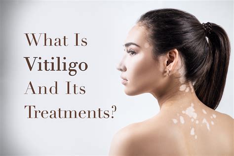What Is Vitiligo And Its Treatment Tatoyanmd Medspa