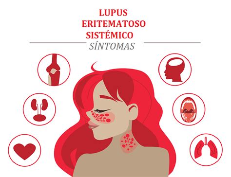 Lupus Eritematoso Sistémico Familia Y Salud
