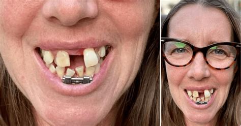 Woman With Crooked Shark Teeth Finally Gets Her Perfect Smile Weird
