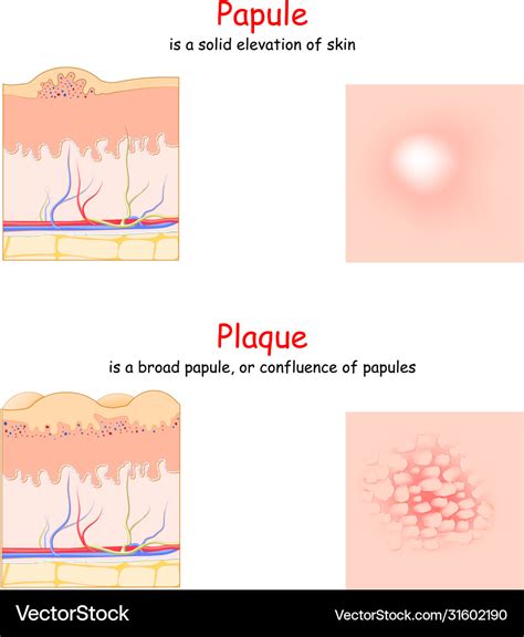 Skin Lesion Papule And Plaque Side And Top View Vector Image Sexiz Pix
