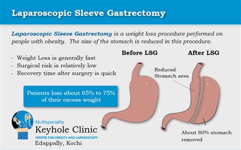 Laparoscopic Sleeve Gastrectomy India Keyhole Clinic Kochi Kerala