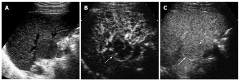 Contrast Enhanced Ultrasound In The Diagnosis Of Nodules In Liver Cirrhosis